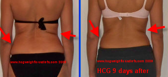 hCG 9 days after hCG sublingual diet formula, notice the back rolls gradually dissapearing hCG 9 days after hCG sublingual diet formula, notice the back rolls gradually dissapearing