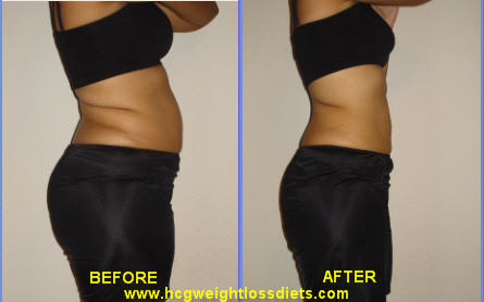 hcg photos after hcg diet