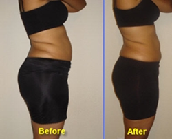 hcg weight loss results