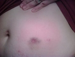 hcg injections bruises belly