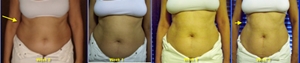 hcg diet pics before and after