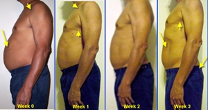 chorionic gonadotropin