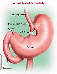 vertical banded gastroplasty