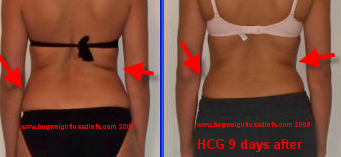 hCG 9 days after hCG sublingual diet formula, notice the back rolls gradually dissapearing