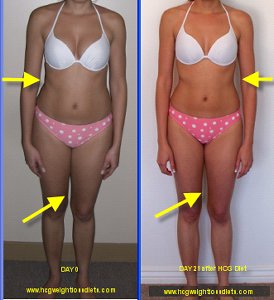 hcg diet before and after photographs