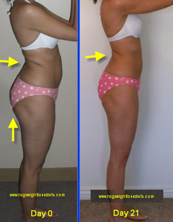 hcg weight loss program, VLCD hcg weight loss program results, 