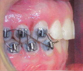 jaw wiring jaw wiring