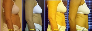 weight loss results with hcg diet